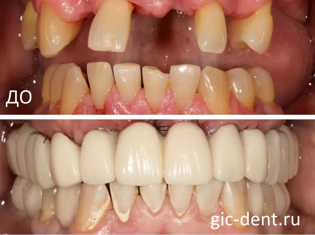 Временное протезирование зубов верхней и нижней челюсти у пациента с сахарным диабетом 1 типа. Немецкий имплантологический центр